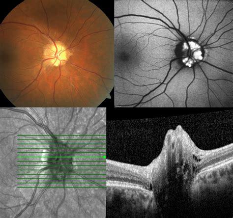 Optic Nerve Head Drusen - RetinaRA