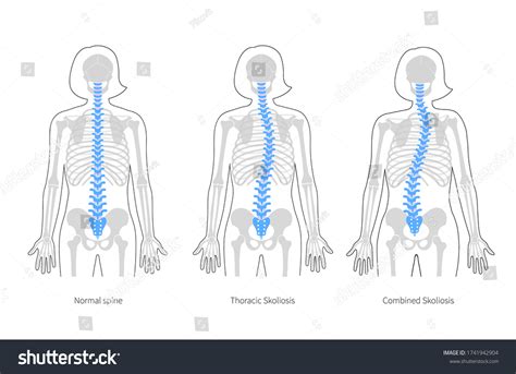 Woman Scoliosis Flat Vector Illustration Types Stock Vector (Royalty Free) 1741942904 | Shutterstock