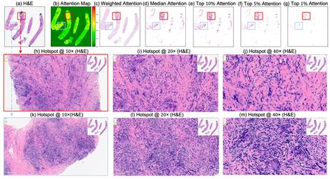 Predicting Neoadjuvant Chemotherapy Response in Triple-Negative Breast ...