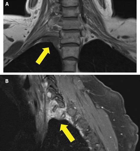 Horner’s syndrome and apraclonidine eye drops | Practical Neurology
