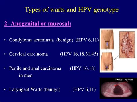 Genital Warts : Types, Treatment, Symptoms, Pictures – HYSK