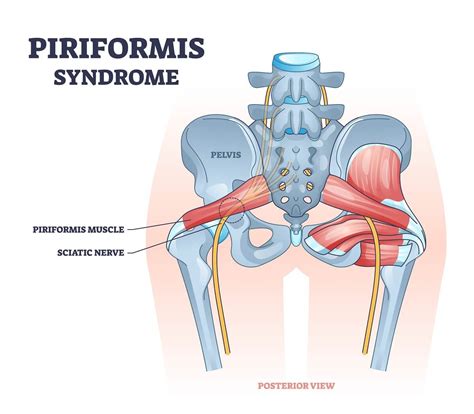Piriformis Syndrome vs. Sciatica: What's The Difference - Coach Sofia Fitness