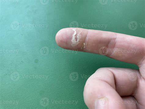 Callus on a man's finger 49641331 Stock Photo at Vecteezy