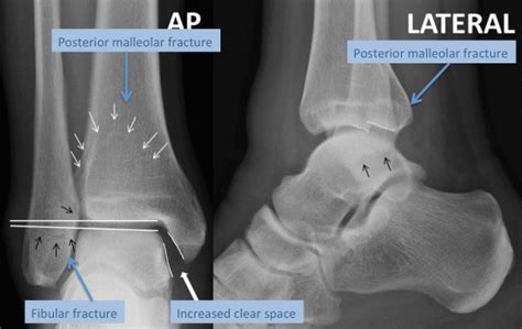 Ankle Fracture | Types & Treatment | The London Foot & Ankle Clinic