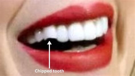 Taylor Swift Teeth: Taylor Swift before and after teeth