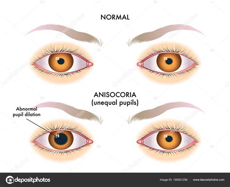 Illustration Vectorielle Anisocorie Pupilles Taille Différente — Image vectorielle rob3000 ...