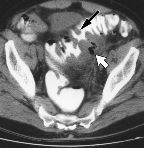 Frequency sensitivity and specificity of individual signs of diverticulitis on thin section ...