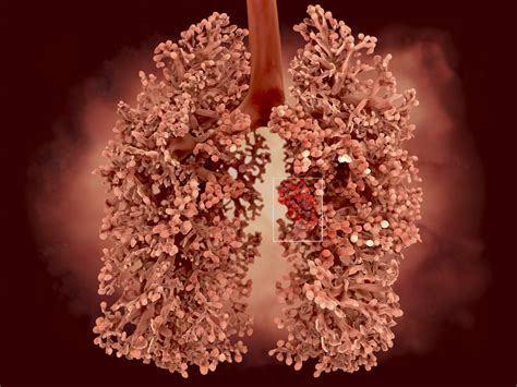 Experts Ring the Alarm Over 'Popcorn Lung' Caused by Vaping — Details ...