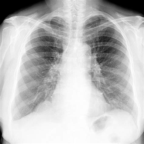 Emphysema life. Emphysema: Stages, Life Expectancy, and Living with End ...