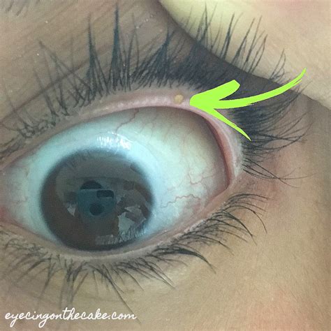 Meibomian Gland Cyst