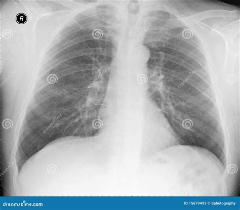 Normal Lateral Chest Xray