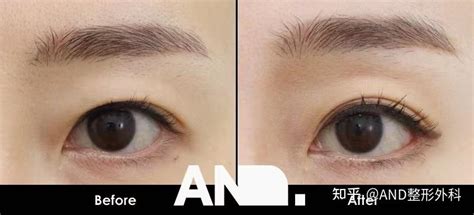 打造美丽双眼皮的同时，使眼睛变大变长的方法:额头提拉术+开后眼角前后事例 - 知乎