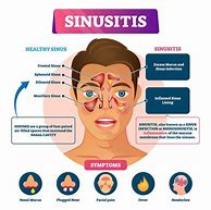 Image result for Sinus Infection Symptoms without Discharge