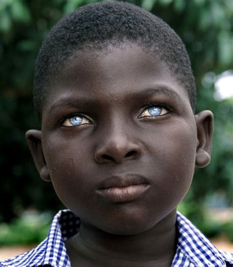 BLACKS WITH BLUE EYES: NATURAL PHENOMENON OR GENETIC MUTATION??