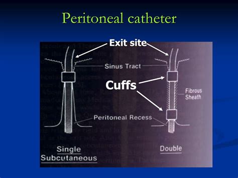 Peritoneal Dialysis Catheter Exit-Site Care at Wade Arnold blog