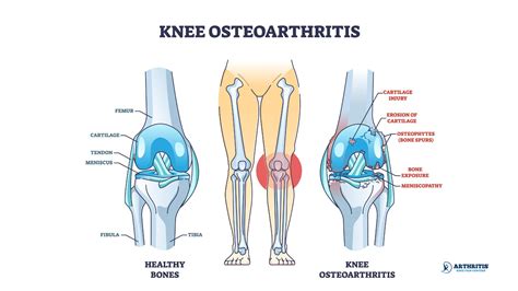 How to Dissolve Bone Spurs Naturally | Arthritis Knee Pain Centers