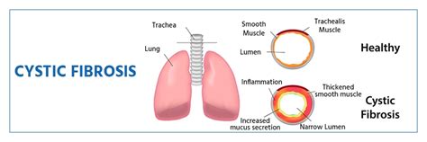 Cystic Fibrosis - Symptoms ,Causes ,Diagnosis and Treatment