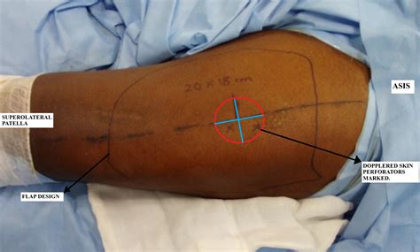 Free Tissue Transfer of the Lateral Thigh and Anterolateral Thigh ...