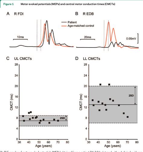 Figure 1 from Benign neonatal sleep myoclonus: A case with a spinal ...