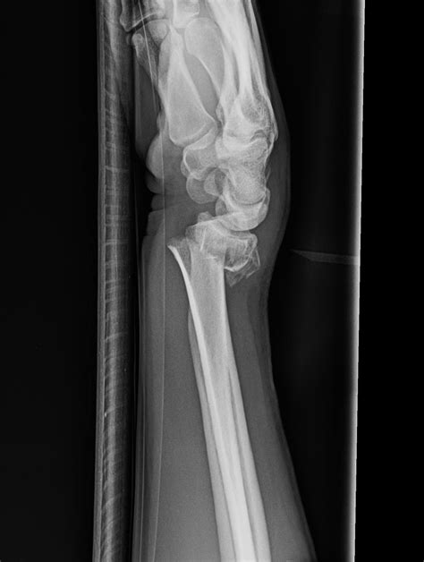 Radius Fracture 的图像结果