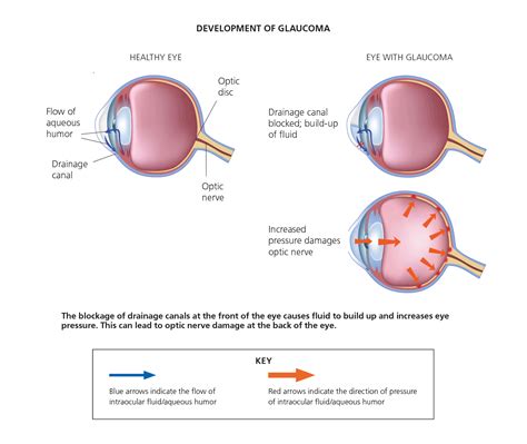 High Eye Pressure Without Glaucoma