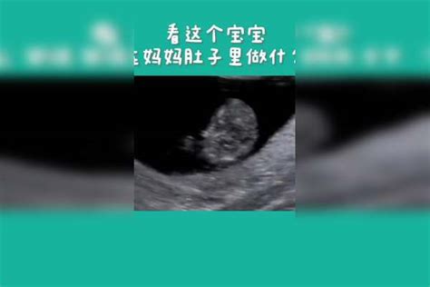 孕11-14周为什么要做超声测NT？ 健康科普