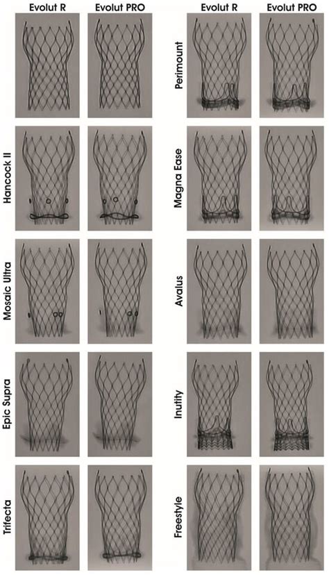 Comparison of Two Generations of Self-Expandable Transcatheter Heart ...