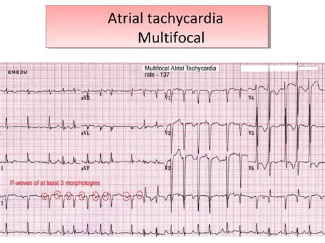 ECG Atrial and Junctional rhythms Dr Sarfaraz | PPT