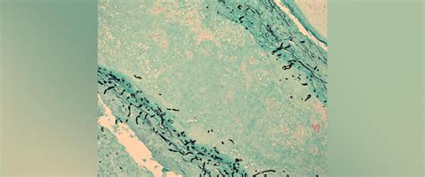 What is fungal meningitis after 2 Americans die from the infection contracted in Mexico - ABC News