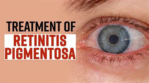 World Retina Day 2022: What Causes Retinitis Pigmentosa And How It is ...