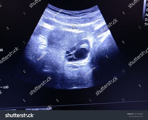 11 Dominant Follicle Images, Stock Photos & Vectors | Shutterstock