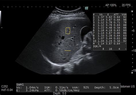 Normal Vs Fatty Liver Ultrasound