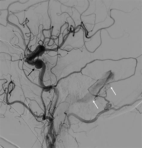 Dural Arteriovenous Fistula | Applied Radiology