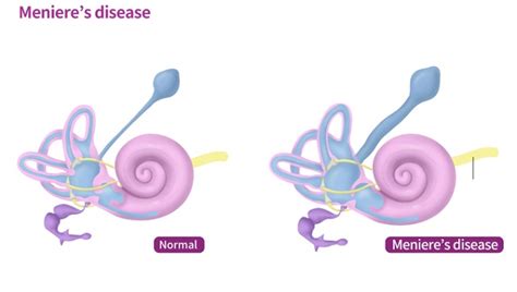 Diagnosis Penyakit Meniere - Alomedika