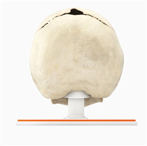 Custom 3D Anatomy Models | Craniosynostosis | Lambdoid Suture | Pfeiffer Syndrome | Crouzon ...