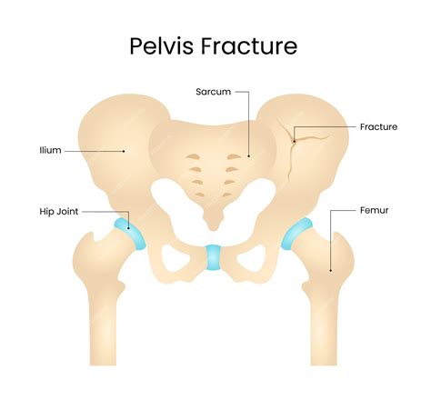 Premium Vector | Diagram of Human Pelvis Fracture