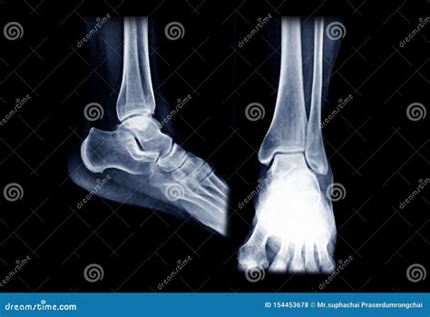 Normal Ankle Xray Ap
