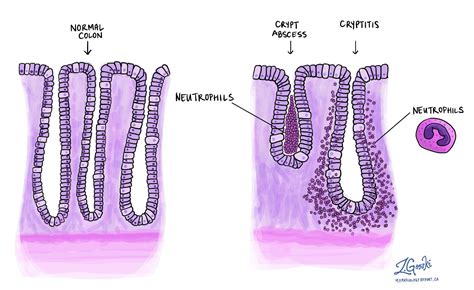 Crypt abscess – MyPathologyReport