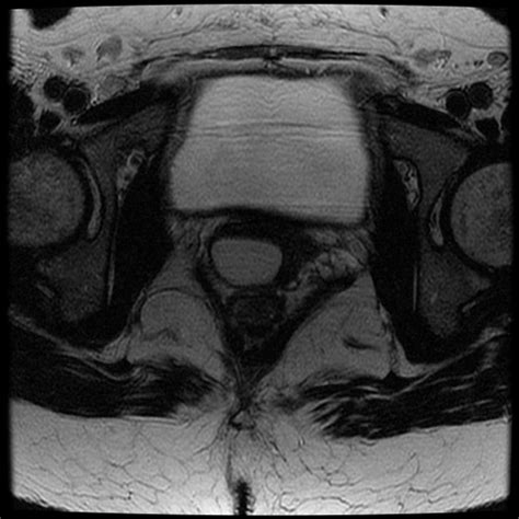 Gartner's Duct Cysts