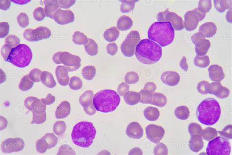 blast cell on blood smear 965834 Stock Photo at Vecteezy
