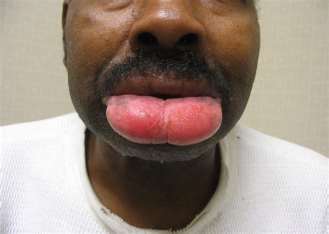 Lip Infection Swollen at Ronald Roe blog
