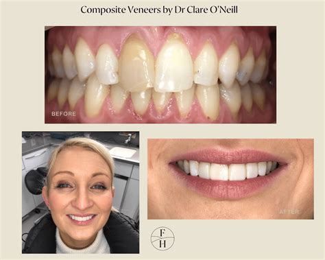 Composite Bonding | Dental Veneers | Finkle Hill Dental