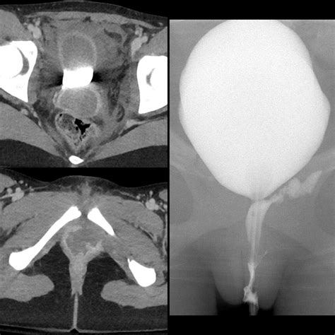 Teenager in an MVA with pelvic pain and vaginal bleeding | Pediatric ...