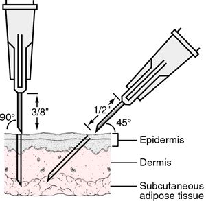 Angle of Injection 的图像结果