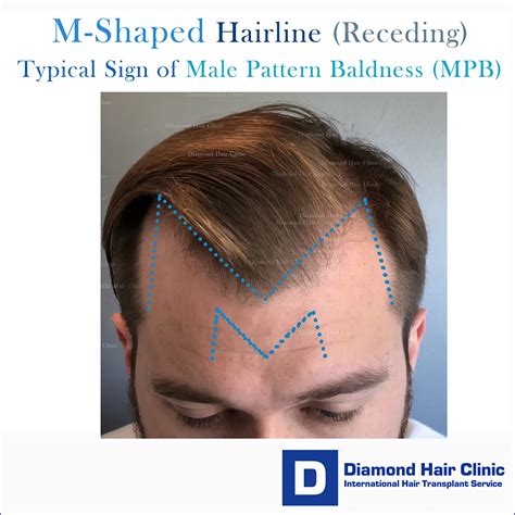 Receding Hairline: Stages, Causes, and Treatments