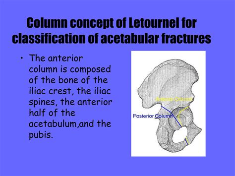 FRACTURES OF ACETABULUM.ppt fractures around hip | PPT