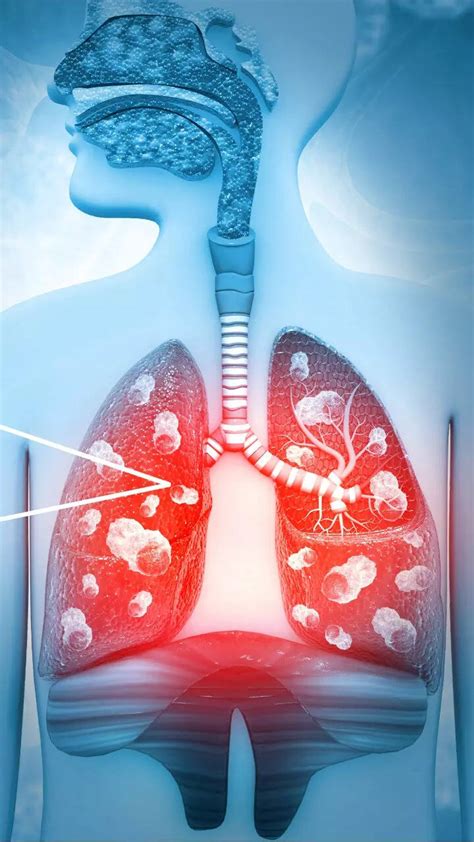 World Tuberculosis Day: Celebrities who fought TB | Times Now