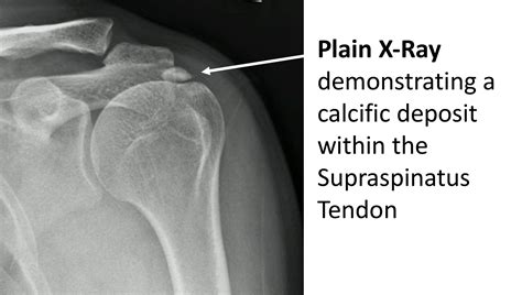 Calcific Tendonitis - Cambridge Shoulder