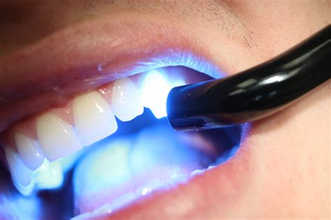 Depth Of Cure Of Composite Resin