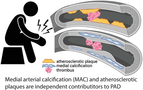 Medial Arterial Calcification: A Significant and Independent ...
